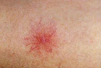 erupții pe picioare din vene varicoase